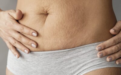 Estrías durante el embarazo: cómo prevenirlas y cuidarlas